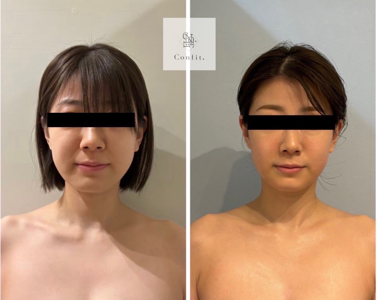 美容鍼で効果倍増！